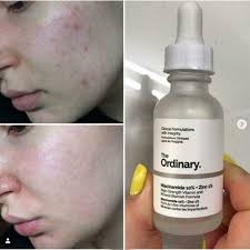 The Ordinary Niacinamide 10% + Zinc 1 % - 20 ml